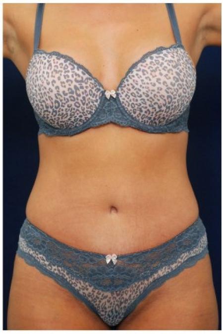 After image 1 Case #82121 - Tummy Tuck