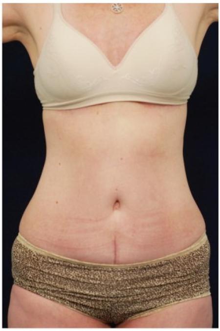 After image 1 Case #82131 - Tummy Tuck