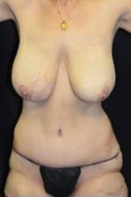 After image 1 Case #85676 - Tummy Tuck 