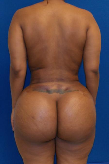 After Case #88321 - Brazilian Buttock Lift 