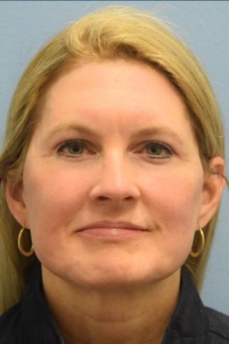 After image 1 Case #86146 - Minimal Access Cranial Suspension (MACS) Lift