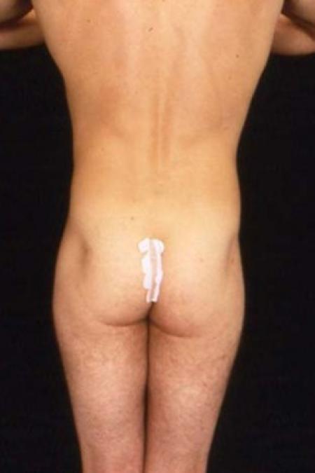 After image 2 Case #81526 - Liposuction