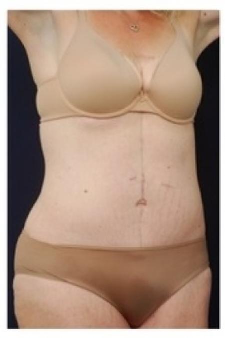 After image 2 Case #81931 - Abdominoplasty