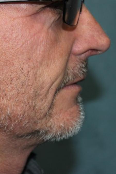 After image 2 Case #87371 - Hair Transplantation San Diego