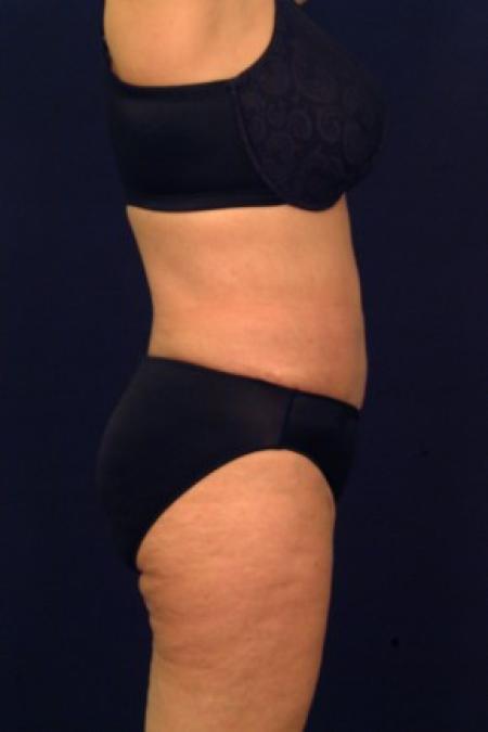 After image 3 Case #87676 - Liposuction