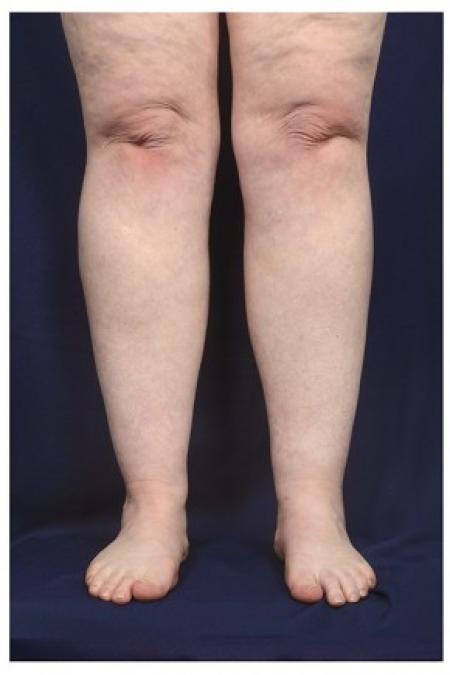 After image 1 Case #86896 - Liposuction