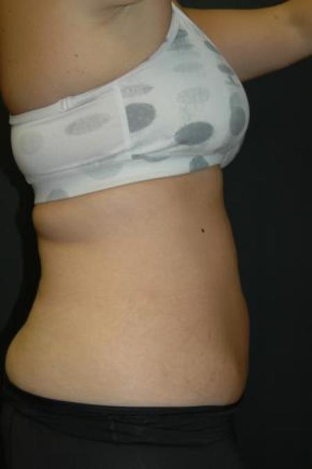 After image 1 Case #80891 - Coolsculpting Procedure on Upper Abdomen