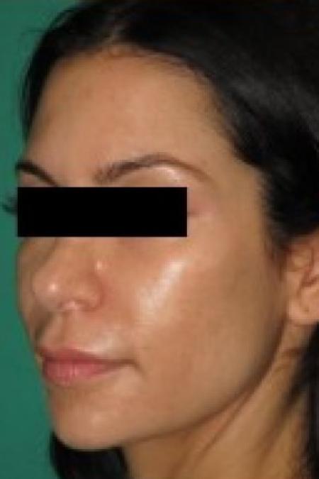 After image 2 Case #85656 - Rhinoplasty 