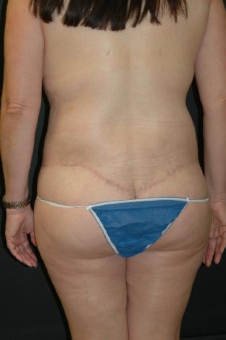 After image 2 Case #81331 - Circumferential Body Lift