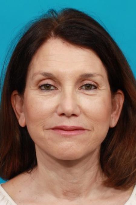 After image 1 Case #84011 - Neck Lift