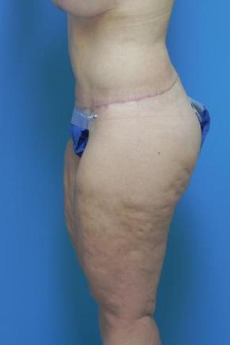 After image 2 Case #80976 - Circumferential Body Lift and Breast Augmentation