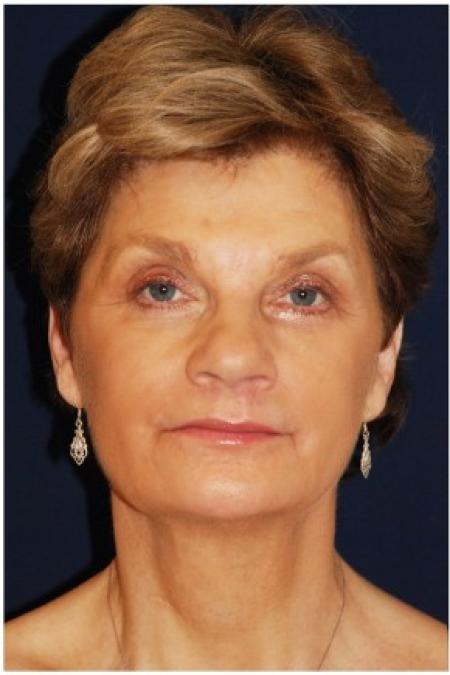 After image 1 Case #82046 - Full Facial Rejuvenation