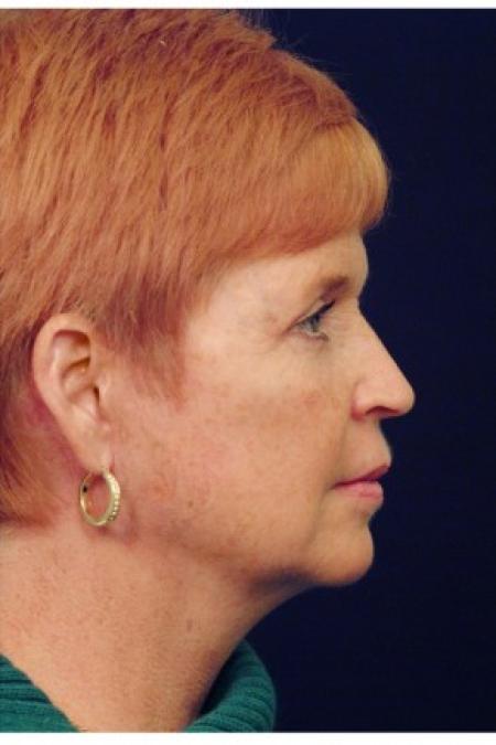After image 3 Case #82141 - Facelift