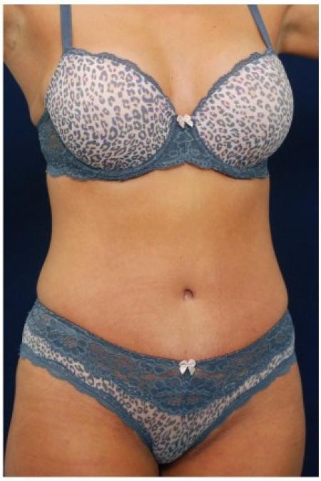 After image 2 Case #82121 - Tummy Tuck