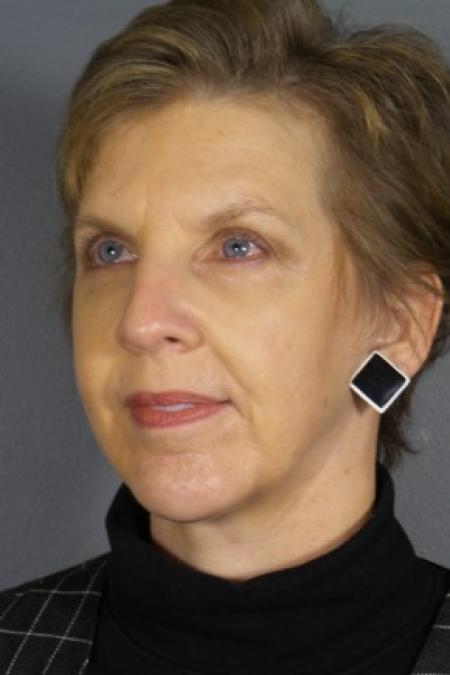 After image 1 Case #83381 - Facelift with Chin Augmentation