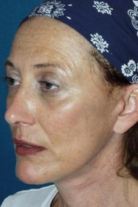 After image 2 Case #80911 - Facelift