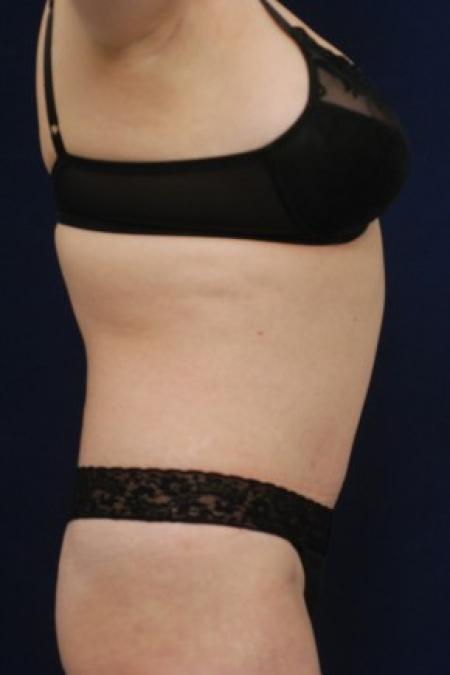 After image 3 Case #87646 - Abdominoplasty