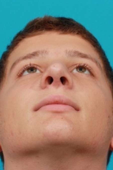After image 4 Case #78766 - Rhinoplasty (Nose Reshaping)