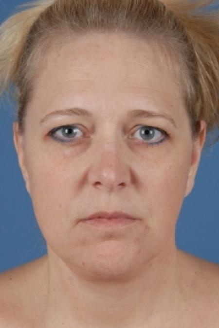 After image 1 Case #79006 - Aesthetic Face