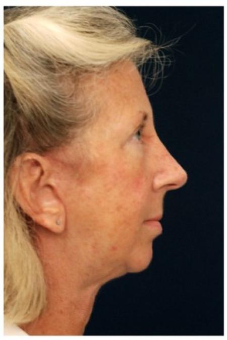 After image 3 Case #87706 - Full Facial Rejuvenation