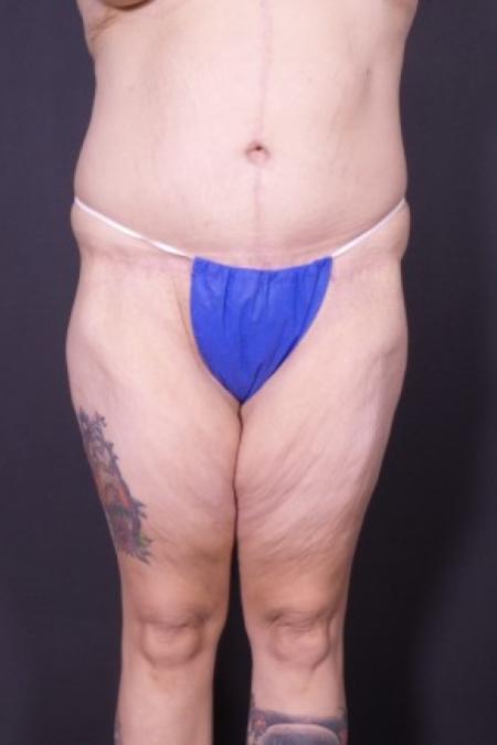 After image 1 Case #84841 - Bodylift