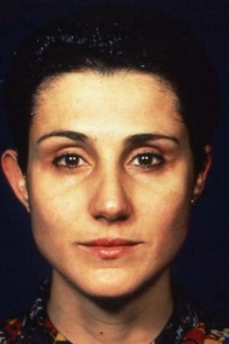 After image 1 Case #81411 - Blepharoplasty
