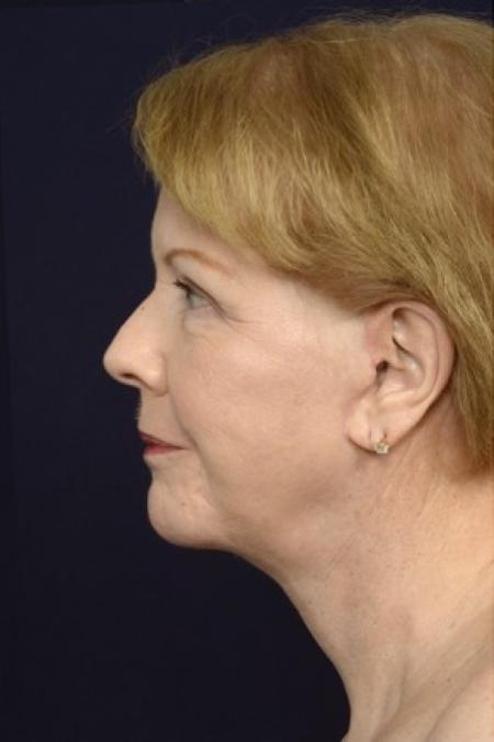 After image 3 Case #87141 - Full Facial Rejuvenation