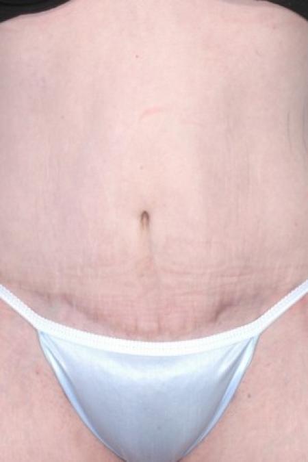 After image 1 Case #81201 - Abdominoplasty and Liposuction