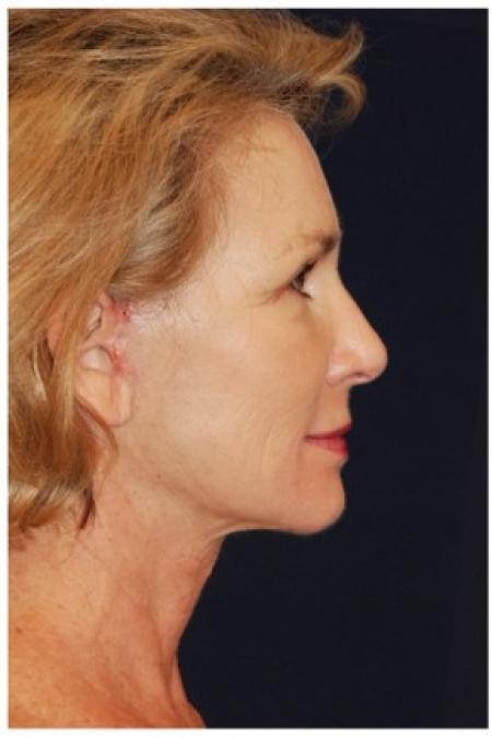 After image 3 Case #82136 - Facelift
