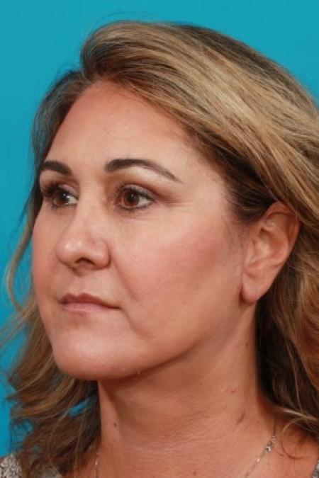 After image 2 Case #86041 - Neck Lift AFTER Kybella