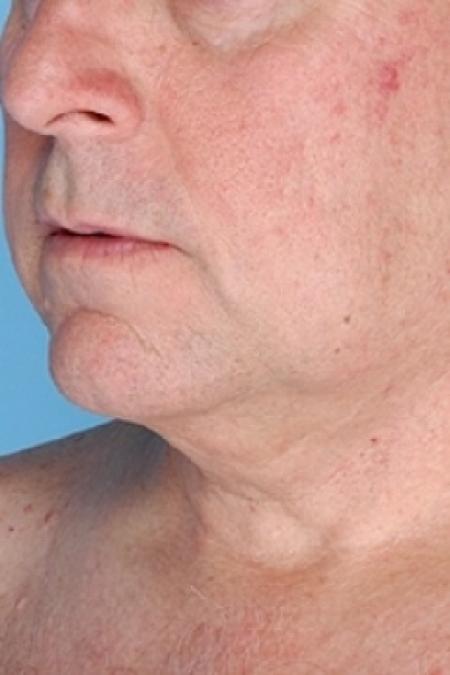 After image 2 Case #79321 - Non-Surgical Focused Ultrasound