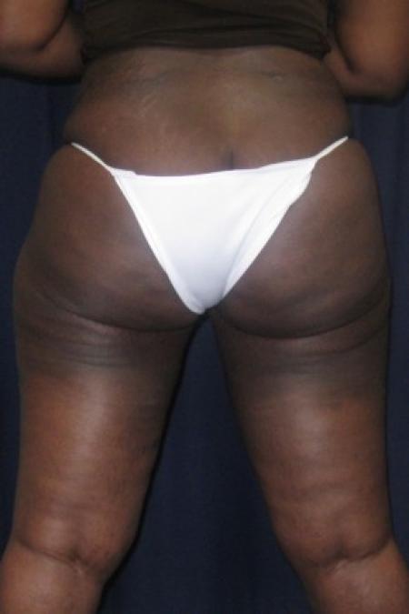 After Case #82351 - Brazilian Buttock Lift