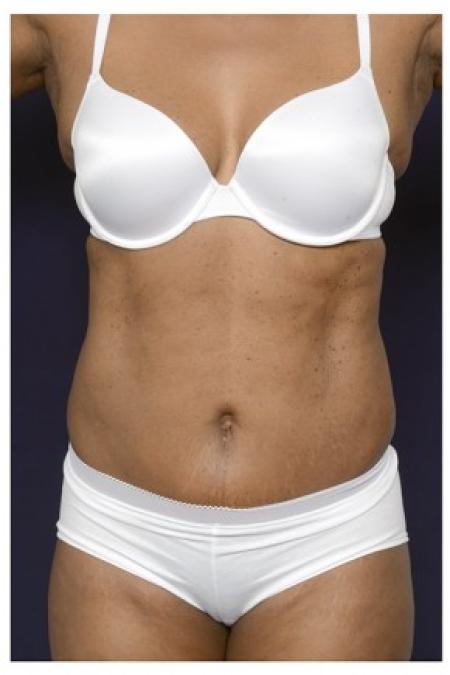 After image 1 Case #84746 - Liposuction