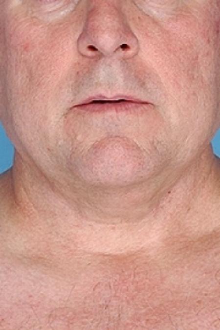 After image 1 Case #79321 - Non-Surgical Focused Ultrasound