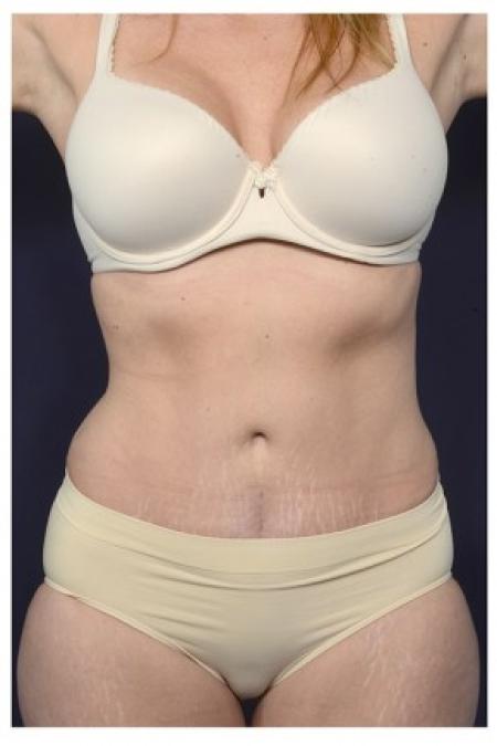 After image 1 Case #86201 - 40 year old woman treated with an Abdominoplasty