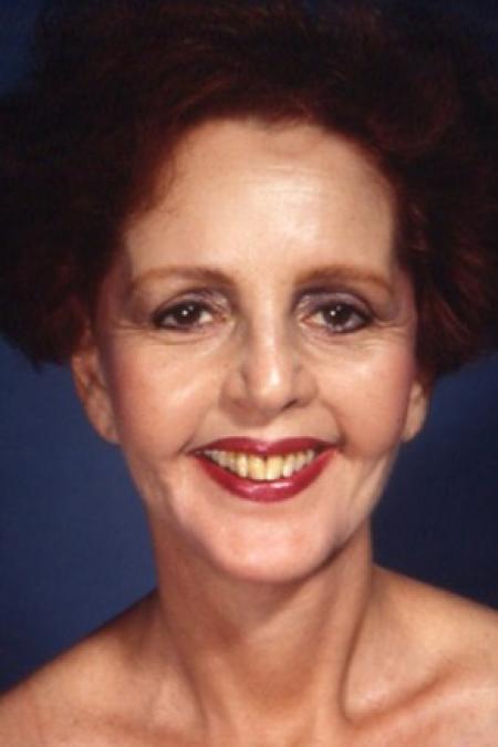 After image 1 Case #81496 - Facelift