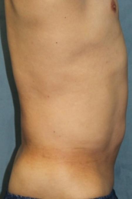 After image 3 Case #80846 - Liposuction
