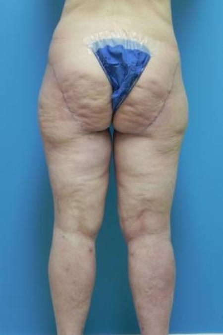 After Case #80951 - Thigh Lift