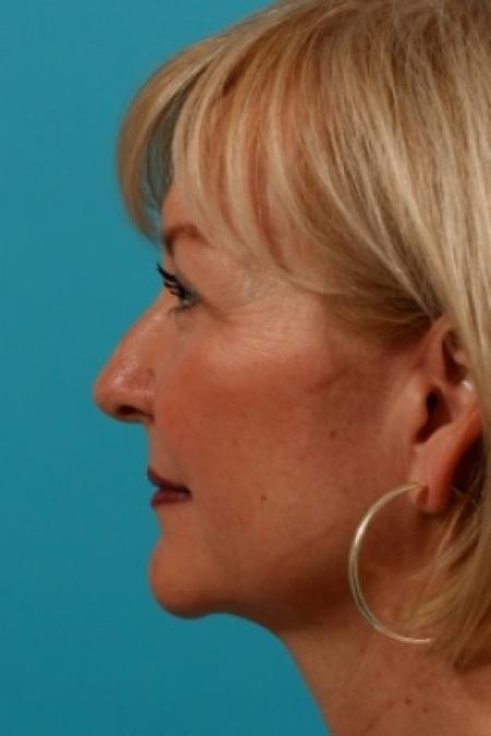 After image 2 Case #78931 - Upper Eyelid Blepharoplasty