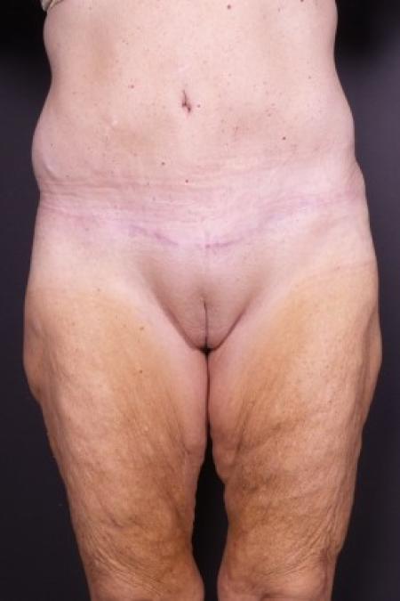 After image 1 Case #85821 - Skin-only Abdominoplasty