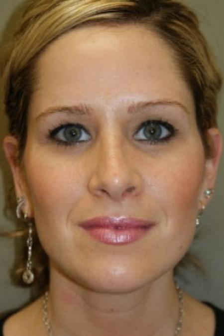 After image 1 Case #81286 - Rhinoplasty