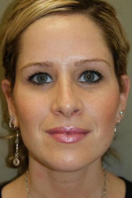 After image 1 Case #80856 - Rhinoplasty