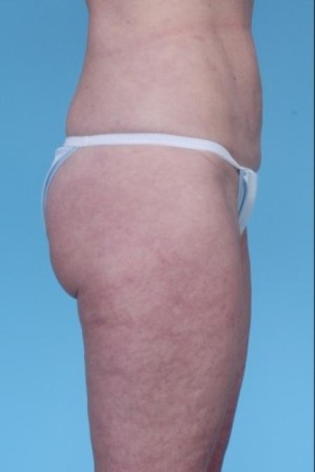 After image 1 Case #82281 - Liposuction