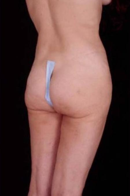 After image 3 Case #81666 - Liposuction