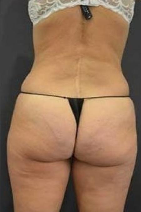 After image 3 Case #85696 - Liposuction 