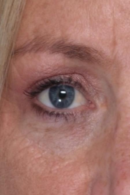After image 3 Case #80591 - Eyelid
