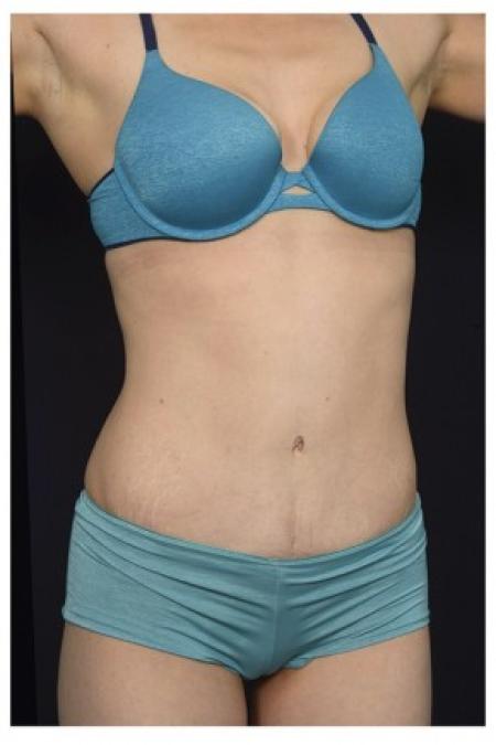 After image 2 Case #84516 - Abdominoplasty