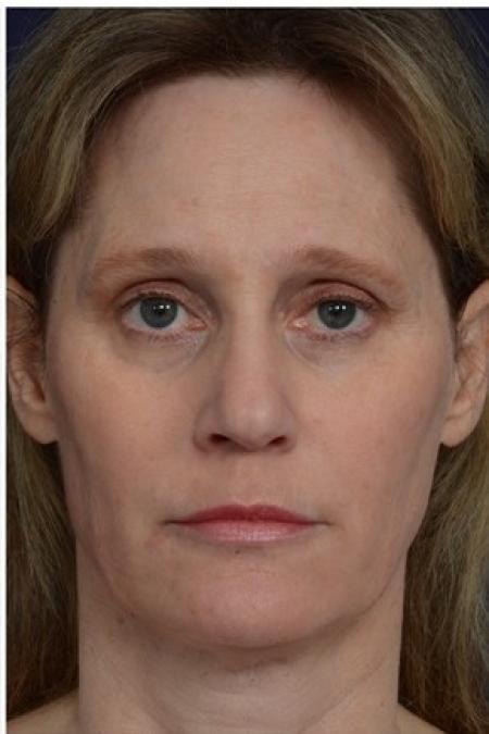 After image 1 Case #86316 - 50 year old woman treated with nonsurgical rhinoplasty