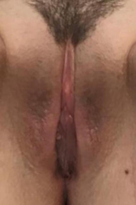 After image 1 Case #88351 - Labiaplasty on a 38 year old female