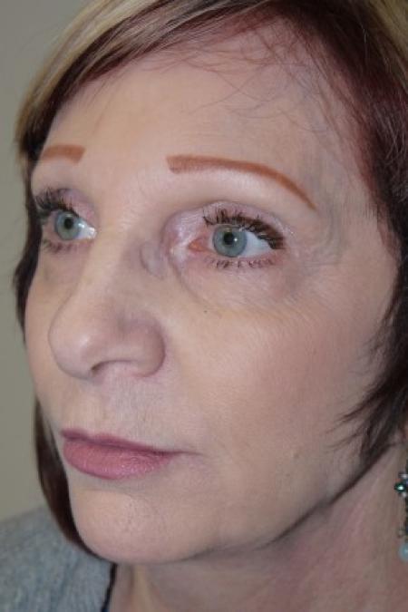 After image 2 Case #82306 - 65 year old, 8 years after facelift and endoscopic brow lift
